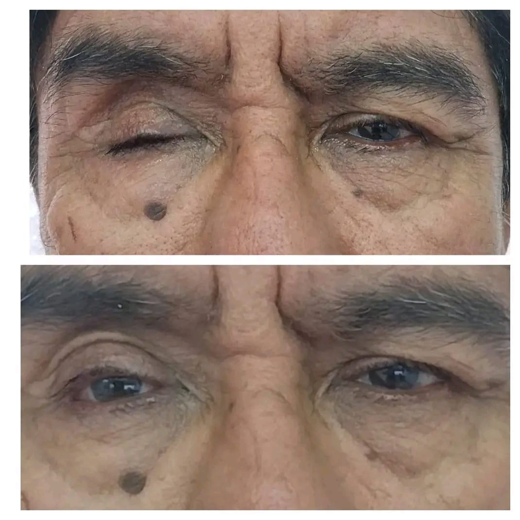 Prótesis Ocular - Servicios 01 Prótesis Ocular - Servicios 01