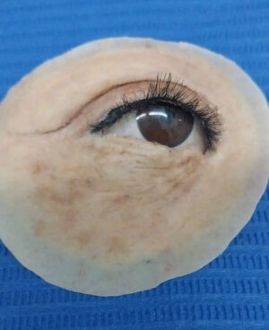 protesis oculopalpebral protesis oculopalpebral